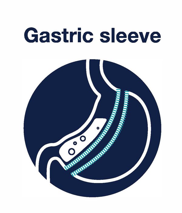 Gastric Sleeve